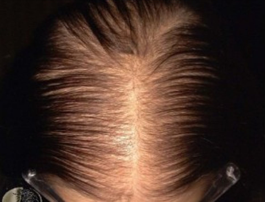 female hair loss