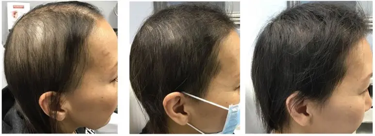 Male pattern hair loss / Female pattern hair loss | Takadanobaba  Dermatology & Plastic Surgery